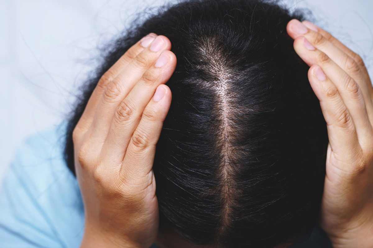 donna mostra capelli diradati